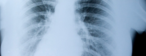 Pneumokonióza